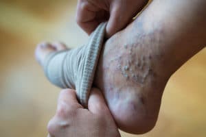 a woman puts a compression stocking on her leg with varicose veins