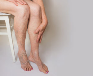 What Is Chronic Venous Insufficiency? - The Vein Center