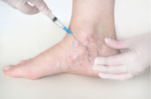 Spider veins on the womans legs sclerotherapy treatment