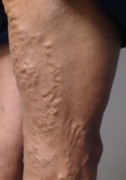 varicose vein before treatment