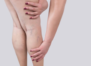 Varicose veins on a legs of woman