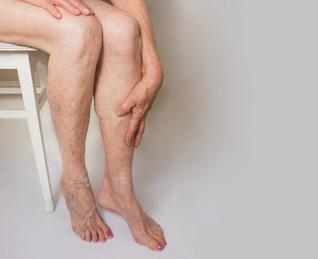 Varicose veins on a female legs