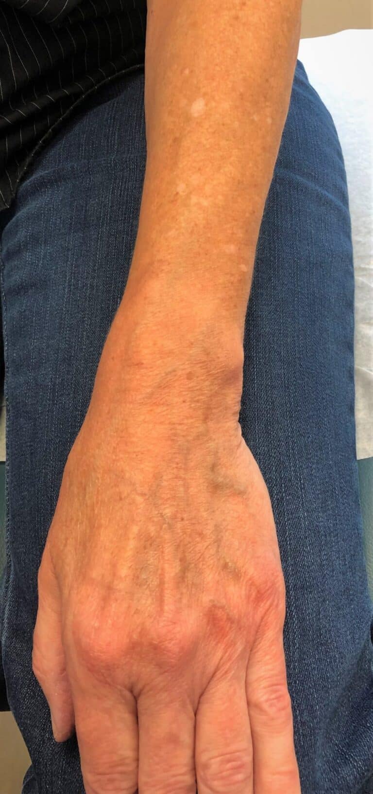 After Image: Hand Treatment - front
