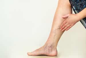 varicose veins