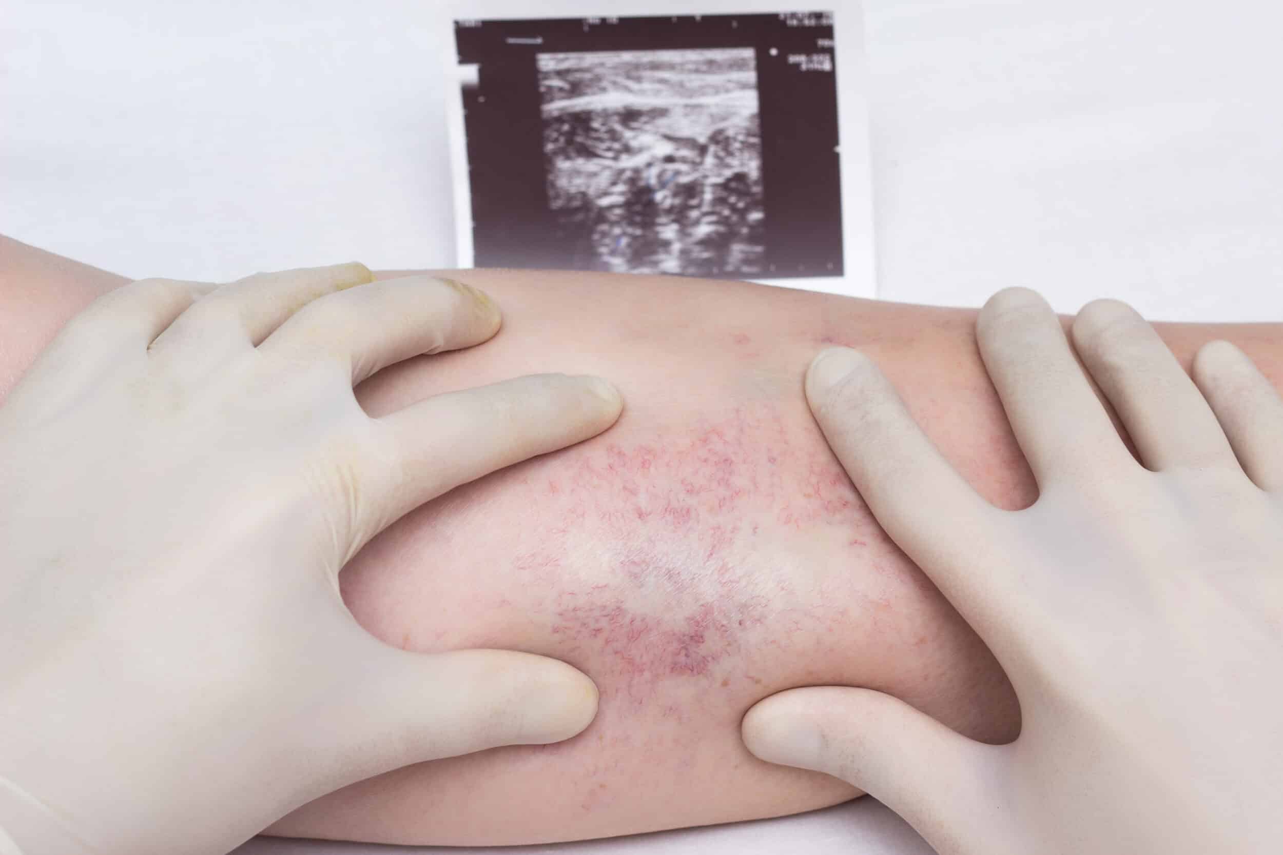 Medical professional examining a patient’s lower leg with visible spider veins and skin discoloration, with ultrasound image in the background