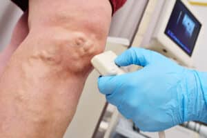 Medical professional using an ultrasound device to examine varicose veins on a patient’s leg